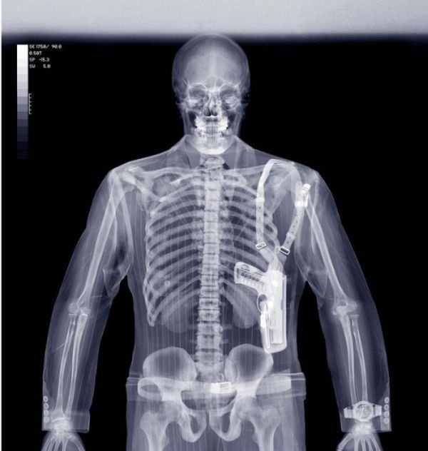 x-ray picture