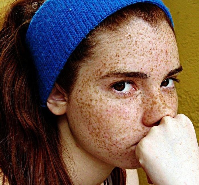 freckled girl