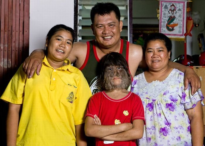 Supatra, child with ambras syndrome, Thailand