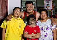 People & Humanity: Supatra, child with ambras syndrome, Thailand